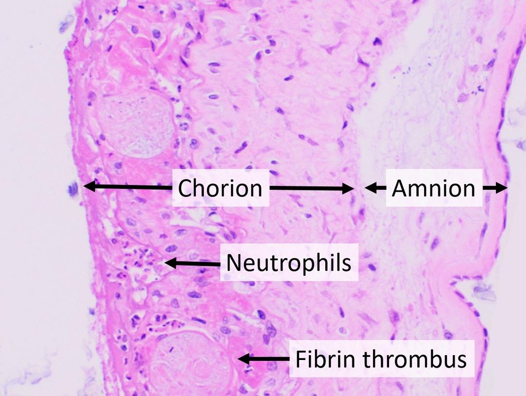 Chorioamnionitis - Wikipedia