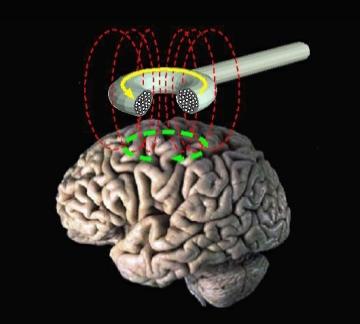 Stimulation magnétique transcrânienne — Wikipédia