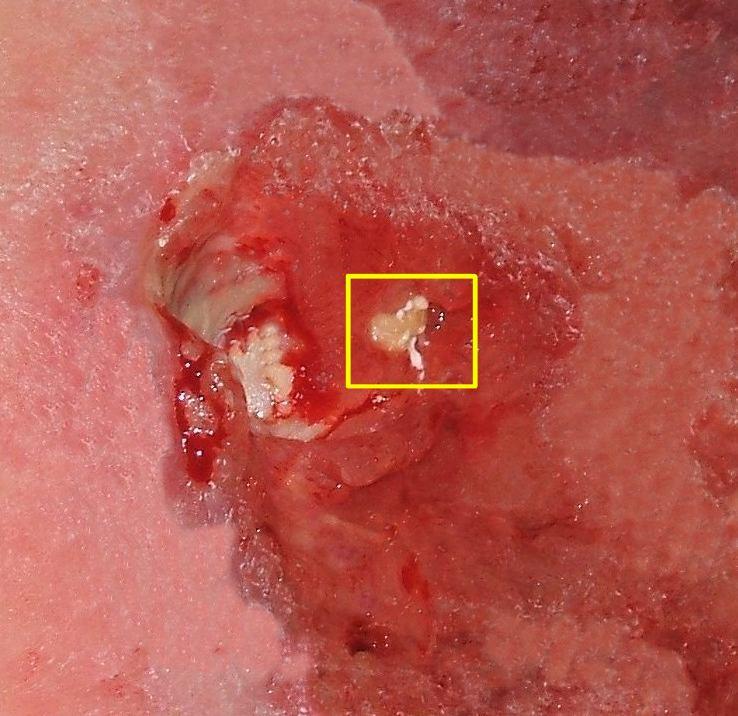 Pressure ulcer - Wikipedia