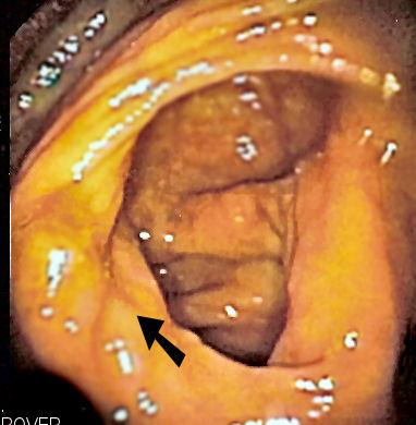 Small intestinal bacterial overgrowth - Wikipedia