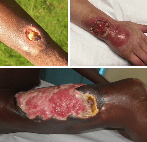 Buruli ulcer - Wikipedia