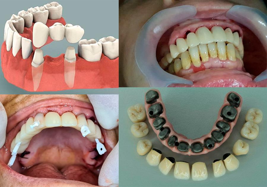 Dental prosthesis - Wikipedia