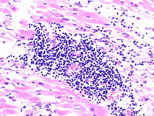 Myocarditis - Wikipedia