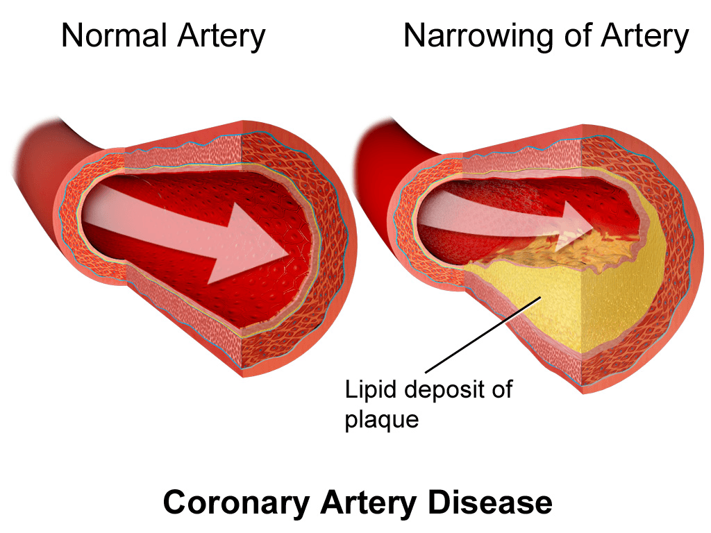 Coronary artery disease - Wikipedia
