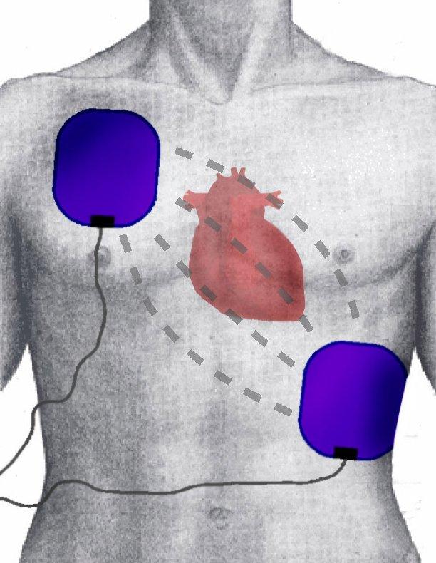 Defibrillation - Wikipedia