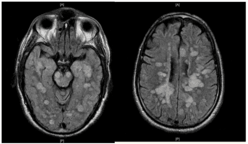 Acute disseminated encephalomyelitis - Wikipedia