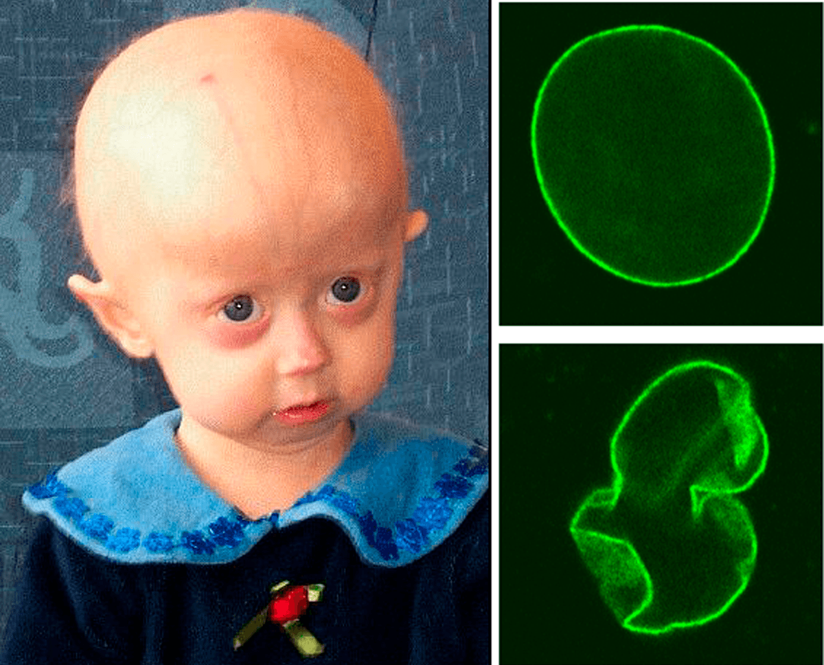 Progeria - Wikipedia