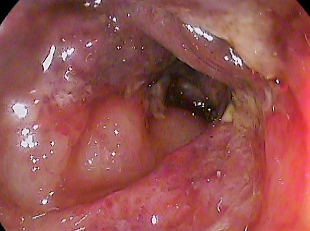 Ischemic colitis - Wikipedia