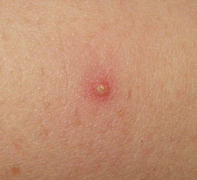 Folliculitis - Wikipedia