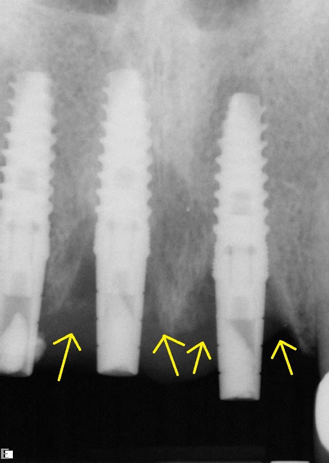 Péri-implantite — Wikipédia