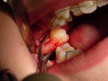 Dental extraction - Wikipedia