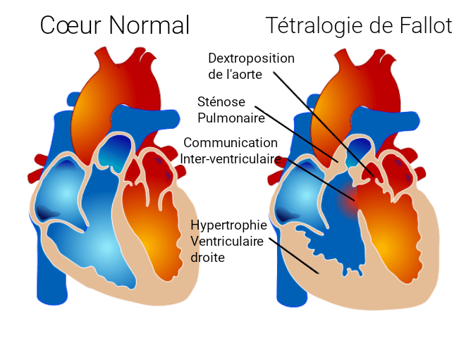 Tétralogie de Fallot — Wikipédia