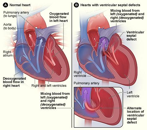 Cardiopathie congénitale — Wikipédia