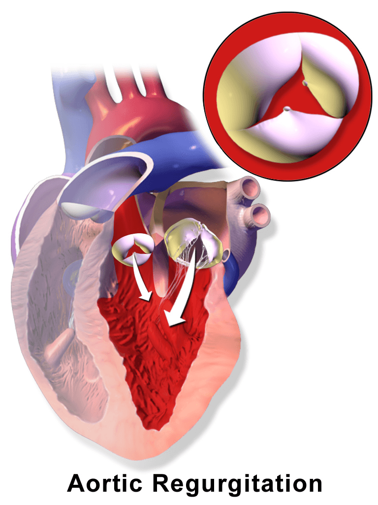 Aortic regurgitation - Wikipedia