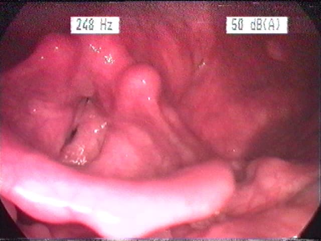 Laryngitis - Wikipedia