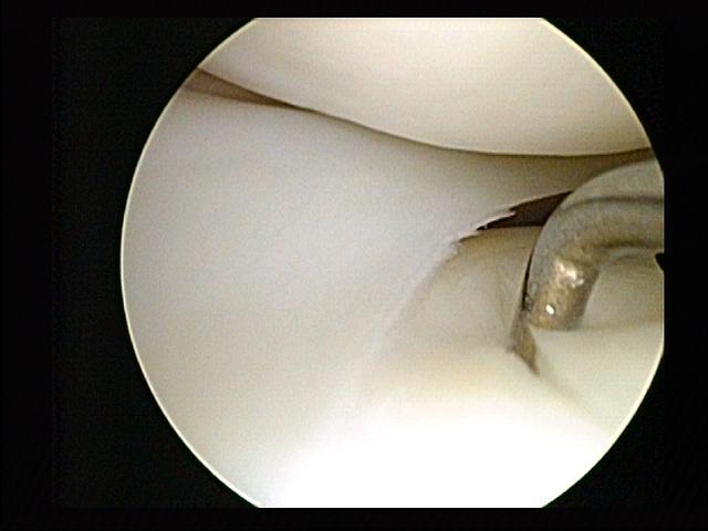 Arthroscopy - Wikipedia