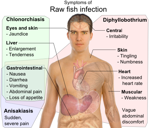 Clonorchiasis - Wikipedia