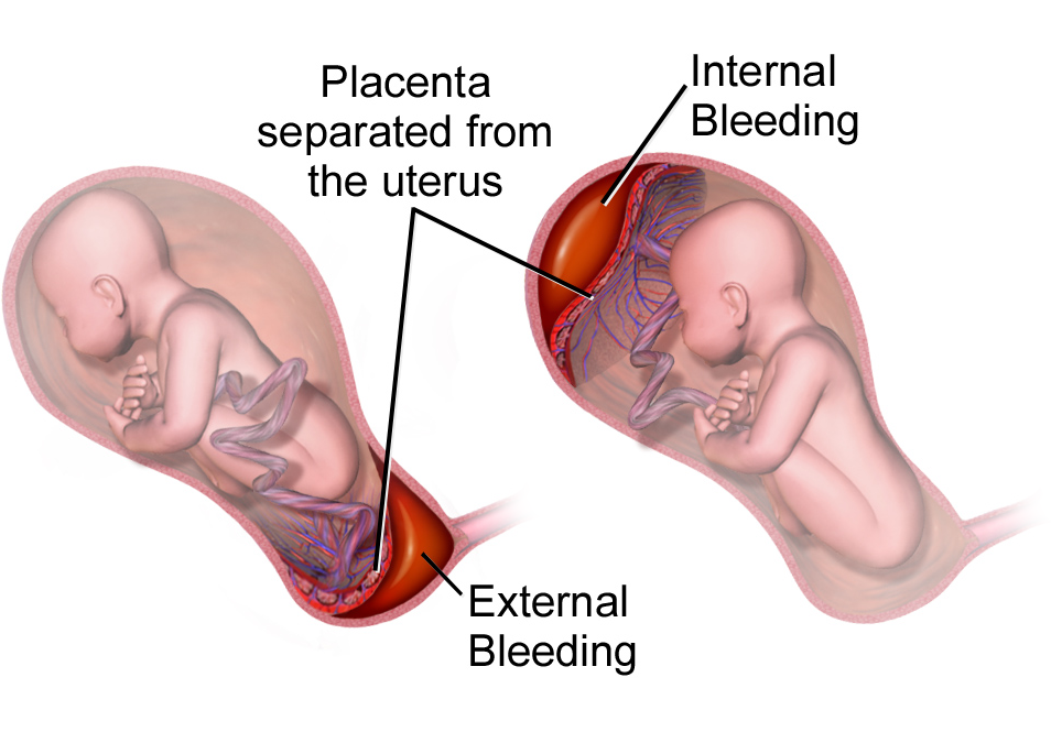 Placental abruption - Wikipedia