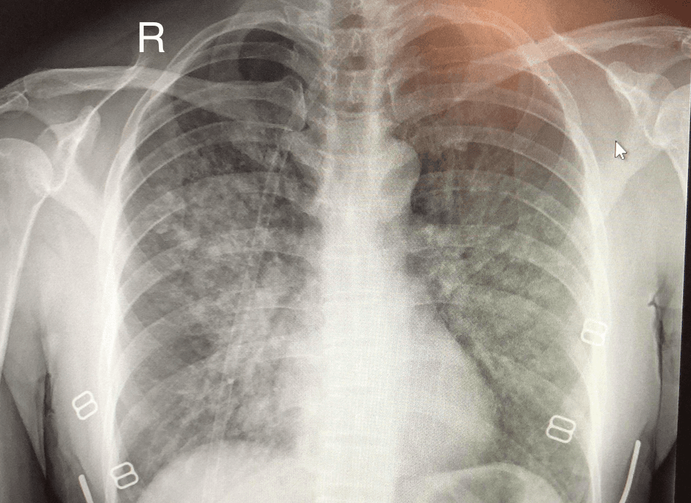 High-altitude pulmonary edema - Wikipedia