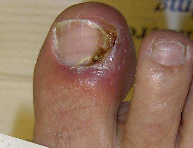 Nail disease - Wikipedia