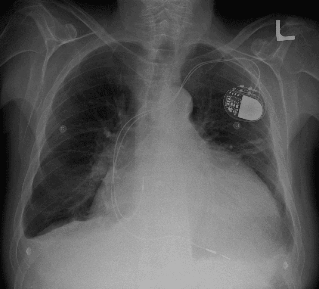 Cardiomegaly - Wikipedia