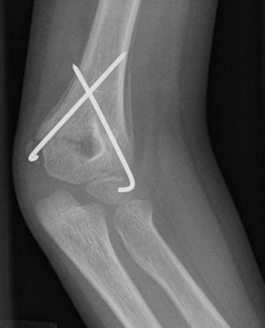 Percutaneous pinning - Wikipedia