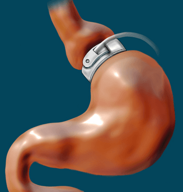 Adjustable gastric band - Wikipedia