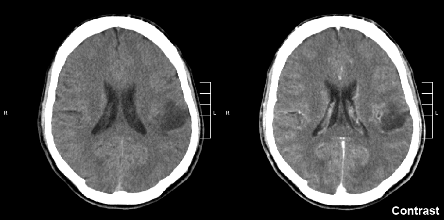 Glioma - Wikipedia