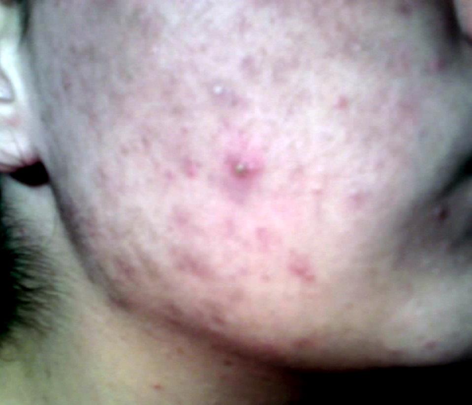 Pimple - Wikipedia