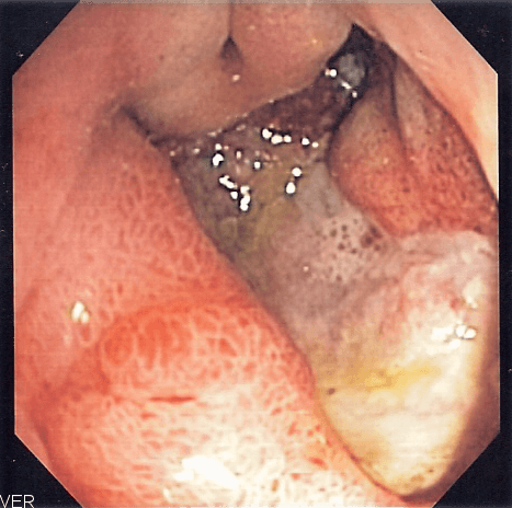 Peptic ulcer disease - Wikipedia