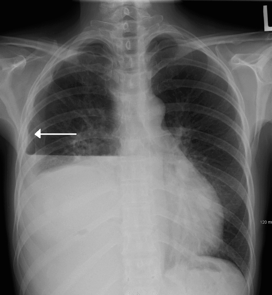 Hydropneumothorax - Wikipedia