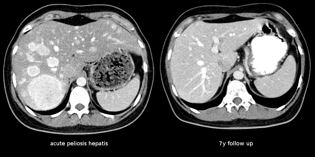 Peliosis hepatis - Wikipedia