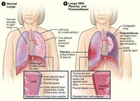 Pleurisy - Wikipedia