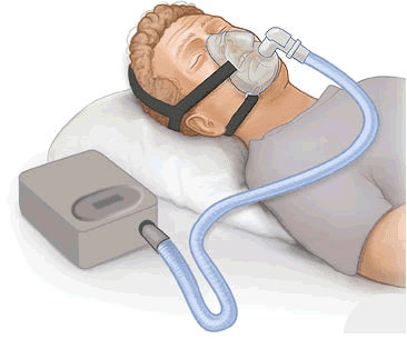 Positive airway pressure - Wikipedia