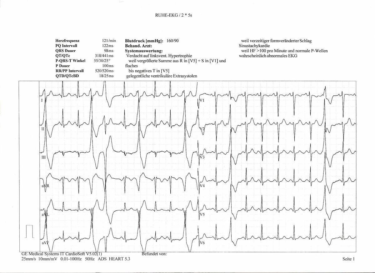 Trouble du rythme cardiaque — Wikipédia