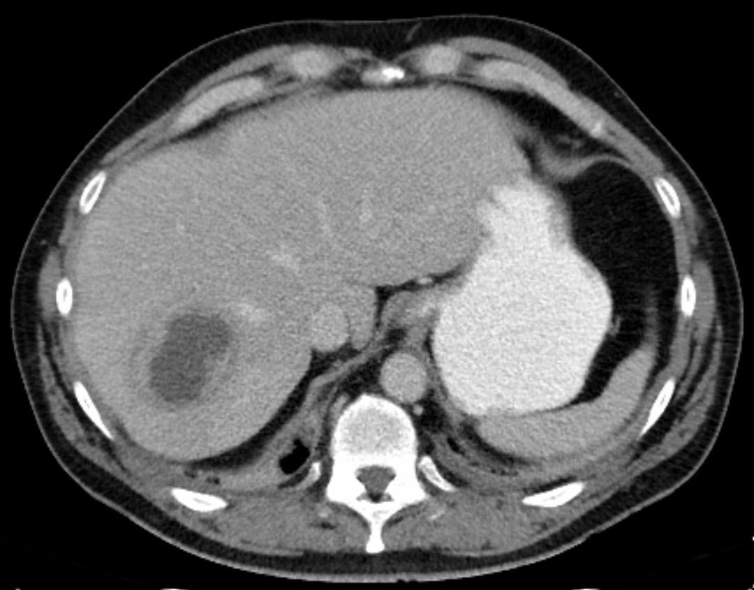 Liver abscess - Wikipedia