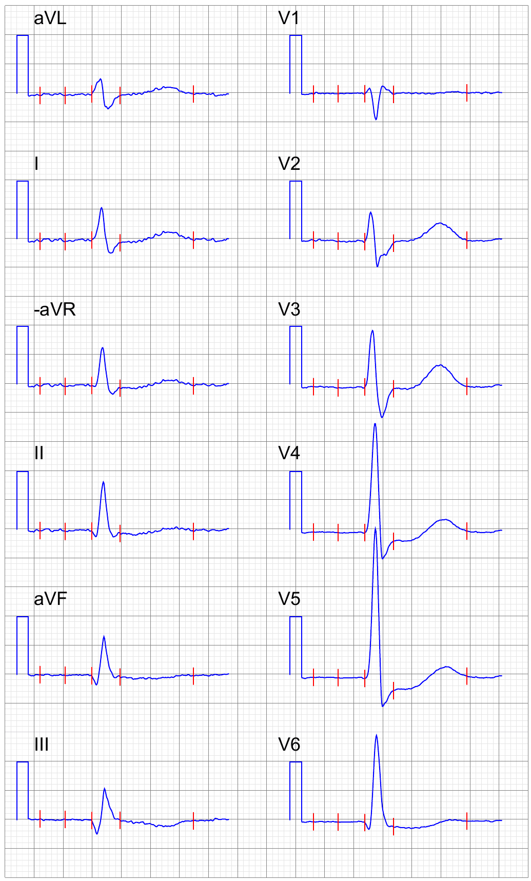 Signal-averaged electrocardiogram - Wikipedia