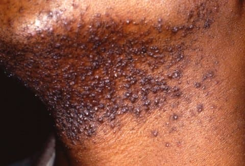 Pseudofolliculitis barbae - Wikipedia