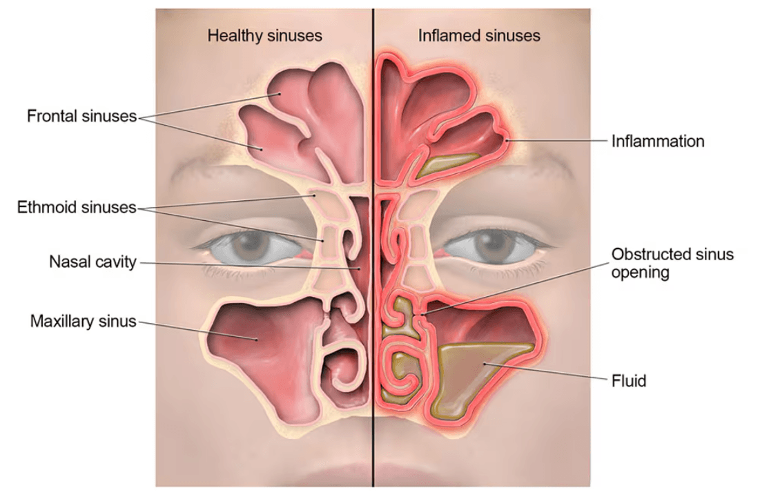 Sinusitis - Wikipedia