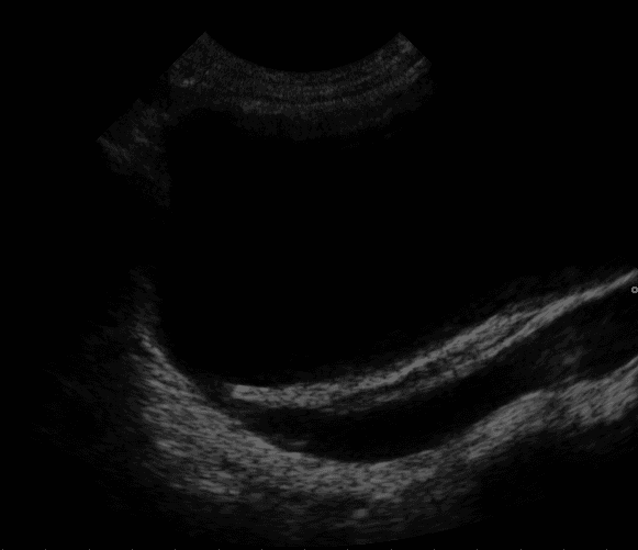 Vesicoureteral reflux - Wikipedia