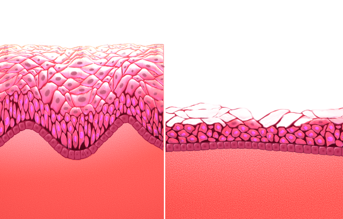 Atrophic vaginitis - Wikipedia