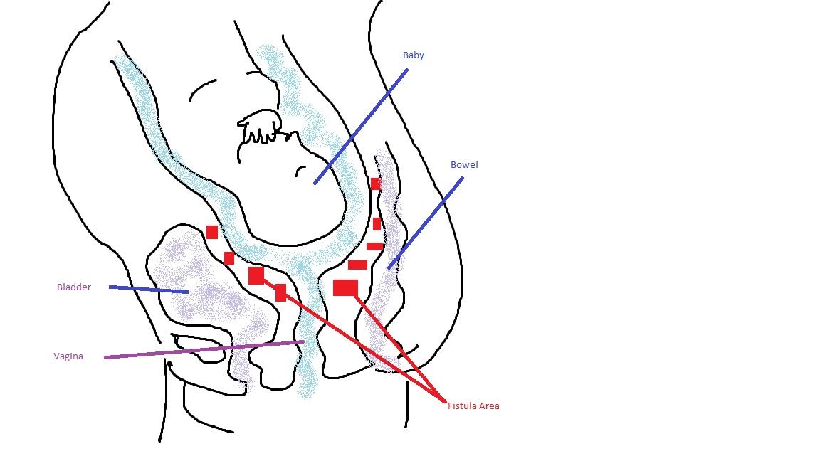 Fistule obstétricale — Wikipédia