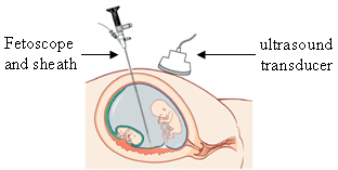 Endoscope - Wikipedia