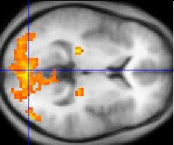 Functional neuroimaging - Wikipedia