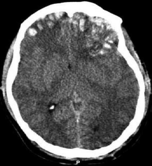 Cerebral contusion - Wikipedia