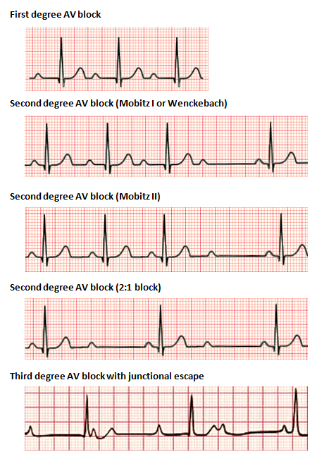 Atrioventricular block - Wikipedia