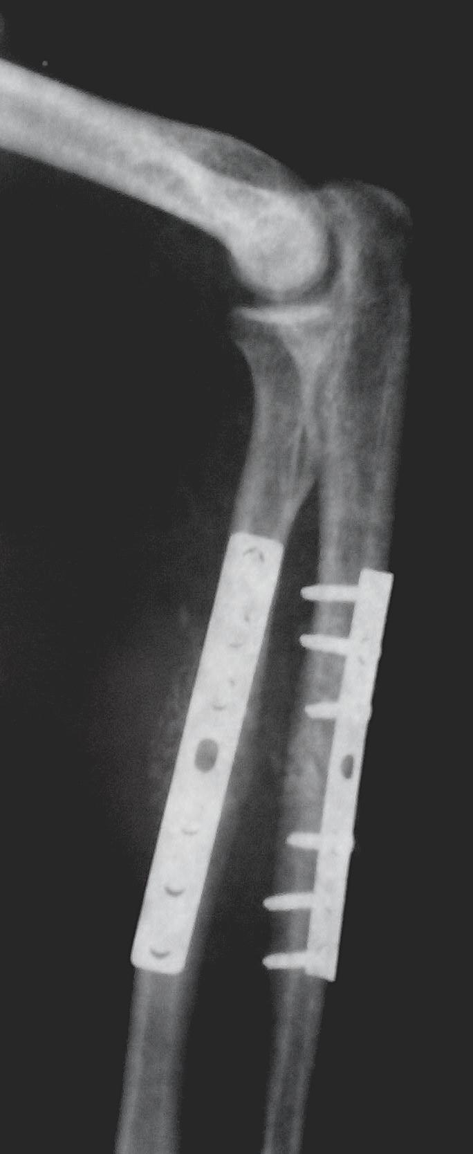 Internal fixation - Wikipedia