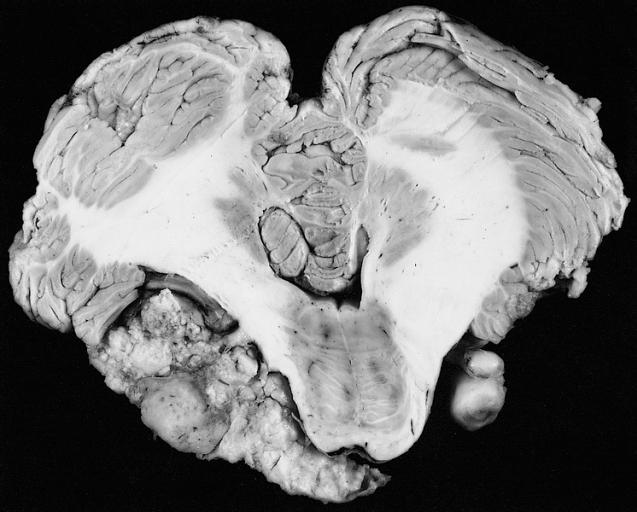 Neurinome de l'acoustique — Wikipédia