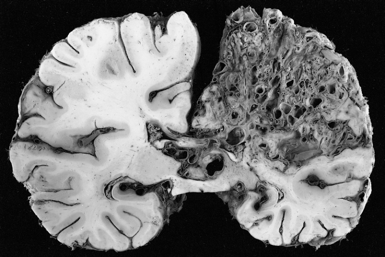 Cerebral arteriovenous malformation - Wikipedia