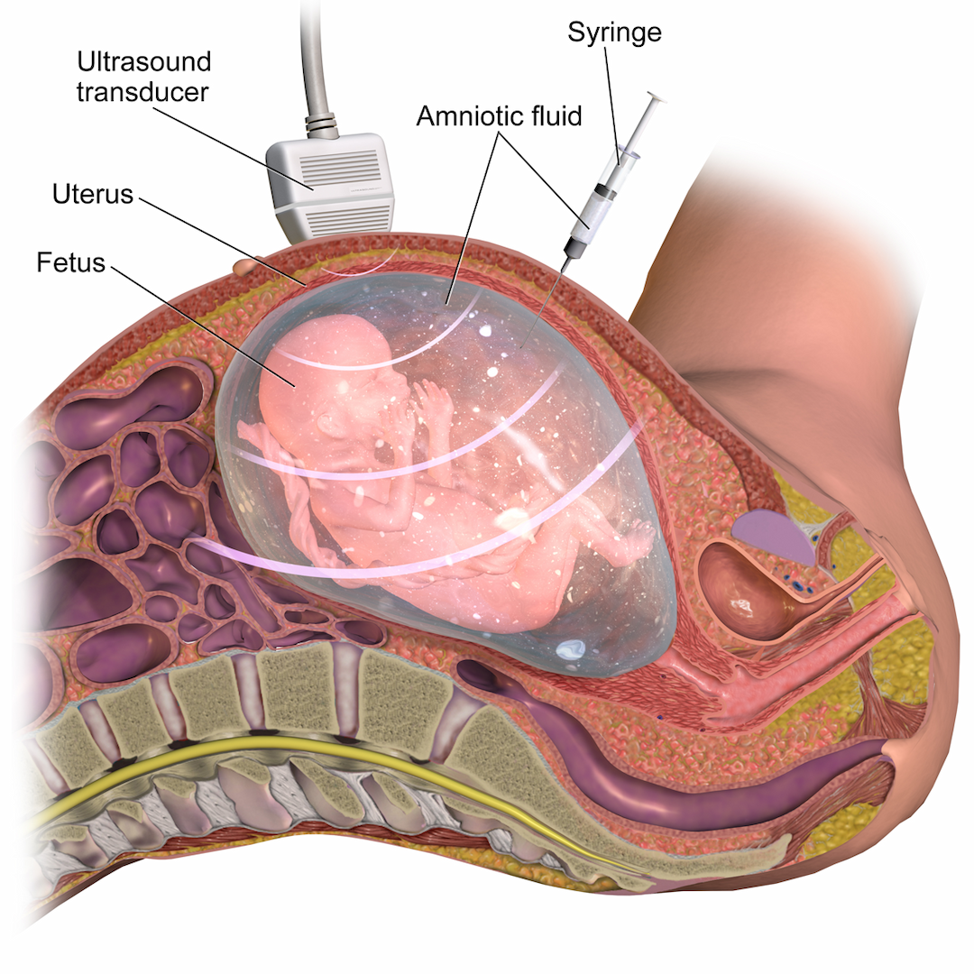 Amniocentesis - Wikipedia